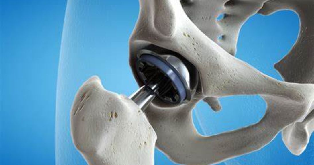 Orthopedic Devices: A Comprehensive Guide